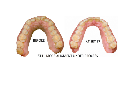 CLEAR ALIGNER