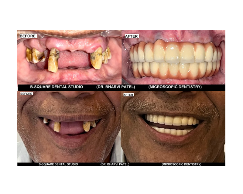Full mouth rehabilitation with Dental Implant