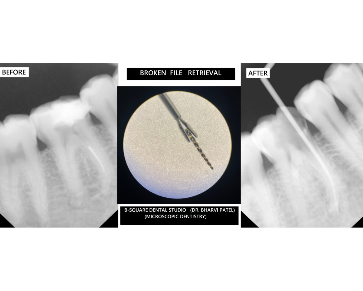 "A Piece of Instrument Broke Inside Your Tooth" What That Actually Means and What Can Be Done